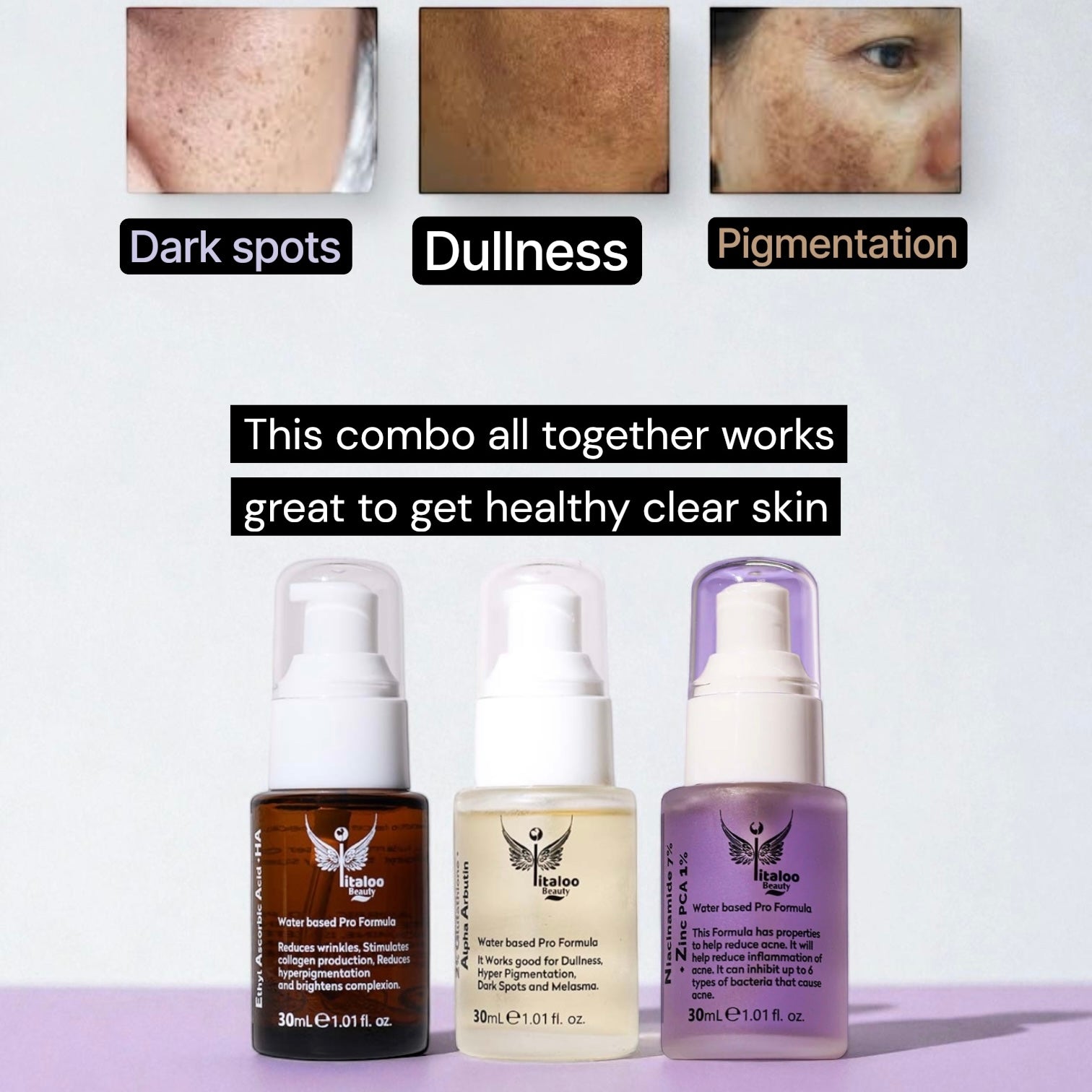 Hyperpigmentation & Acne